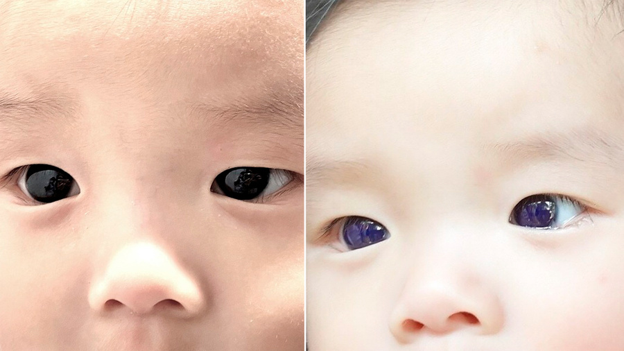 Глаза 6-месячного малыша из Таиланда стали фиолетовыми из-за лекарства от ковида