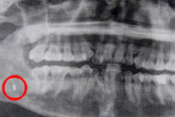 В Таиланде врачи извлекли из челюсти пациентки забытый инструмент